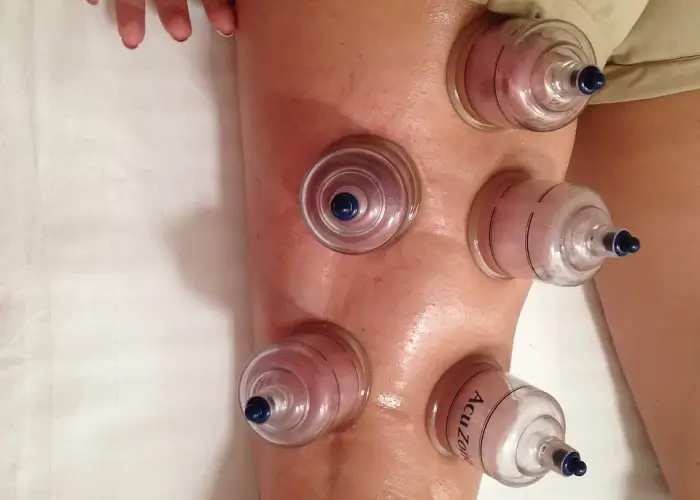 What is Cupping What is Cupping